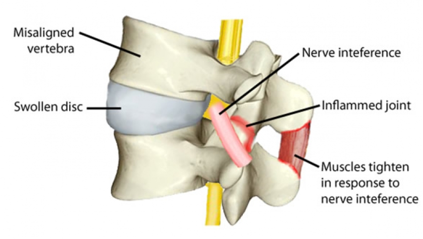 Quiropractico Quiropraxia subluxacion