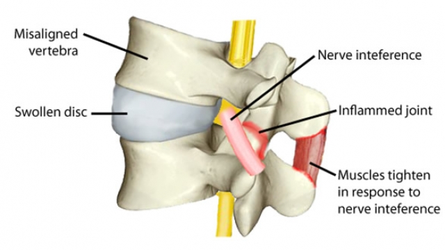 Quiropractico Quiropraxia subluxacion